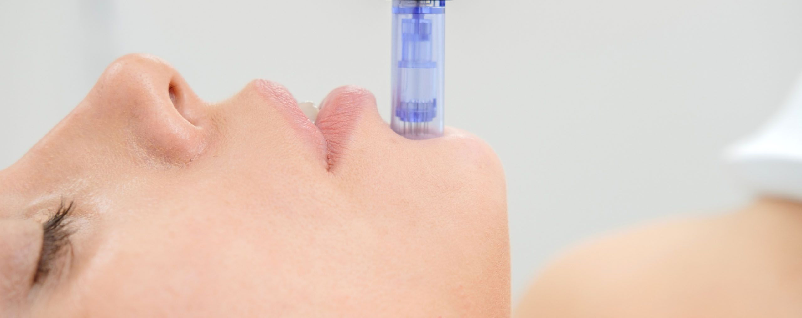  Microneedling