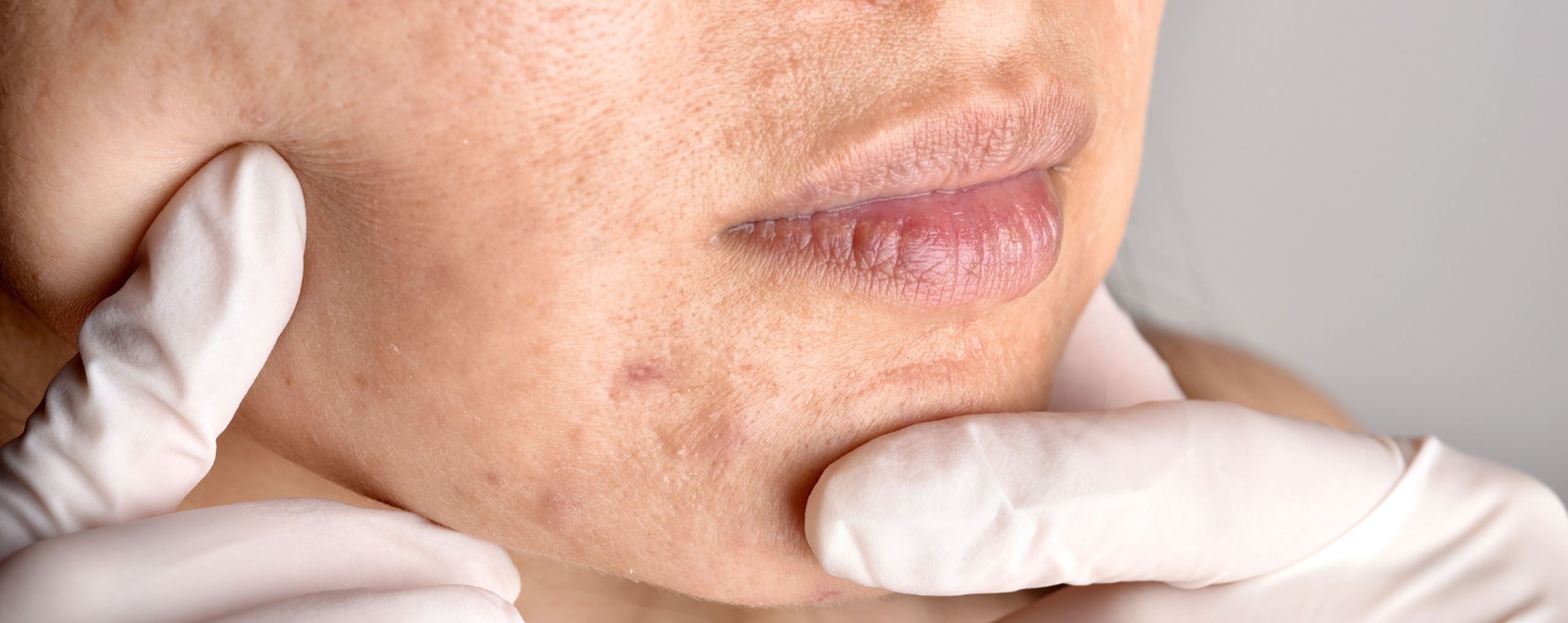 Acne / Onzuiverheden